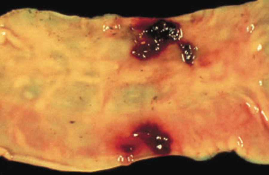 Nodules provoqués par Œsophagostomum radiatum sur le gros intestin de l’hôte ©École vétérinaire de l'Université de Pennsylvanie